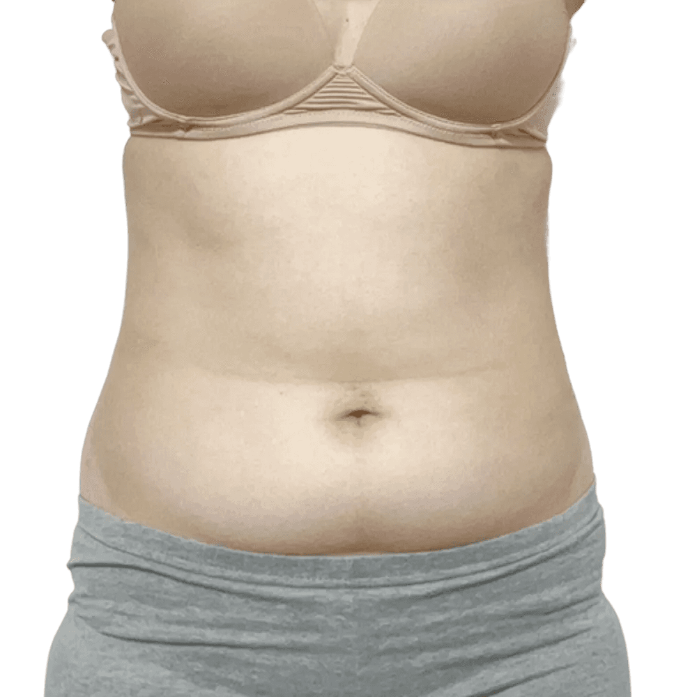 복부 수술 전 사진 2